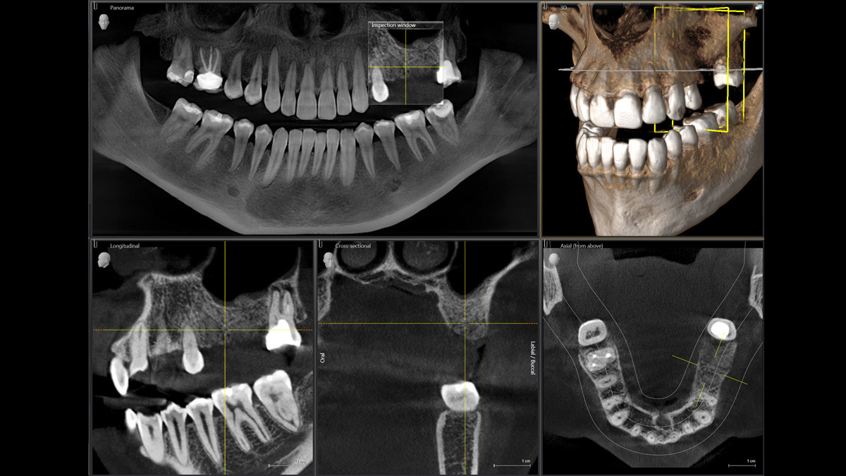 3D-Aufnahme eines Implantatfalls
