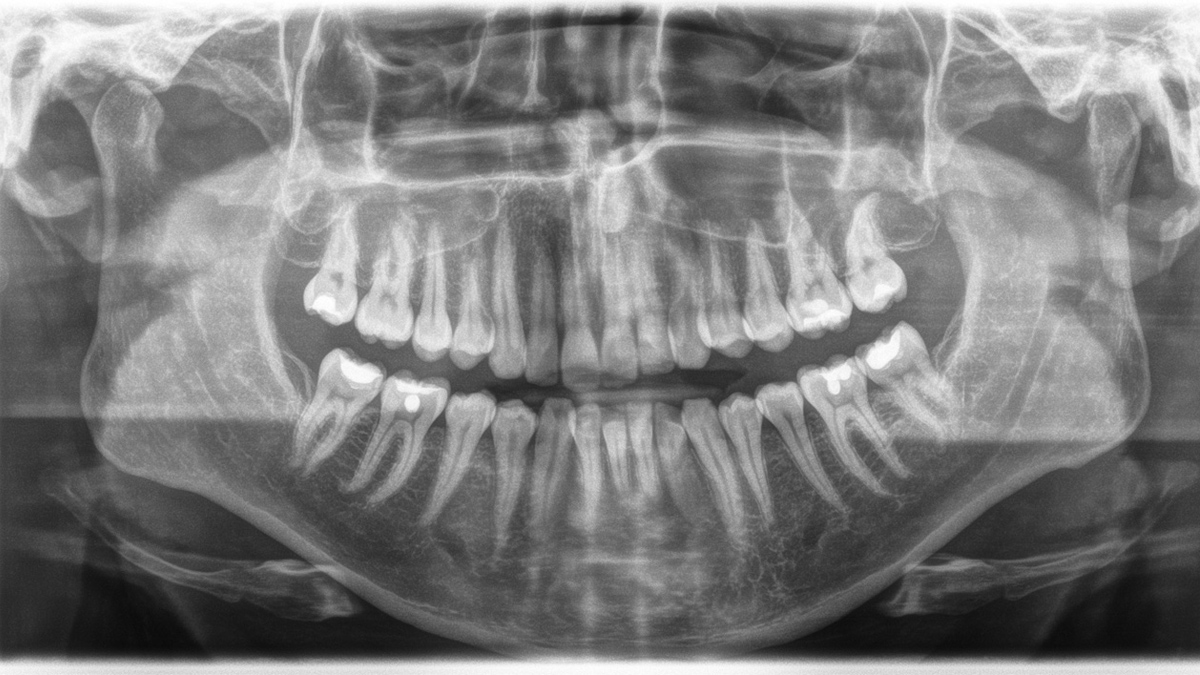 Radiographie montrant une dentition complète traitée prophylactiquement. 