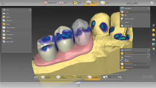 inLab CAD Software, Gingiva element design