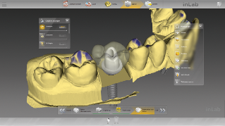inLab CAD Software, Implantology module, individual abutment on TiBase