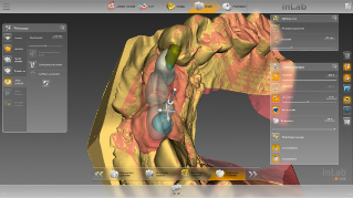 inLab CAD Software, Implantology module, screw-channel tool