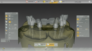 inLab CAD Software, Implantology module, screw retained bridge, multi-unit abutments