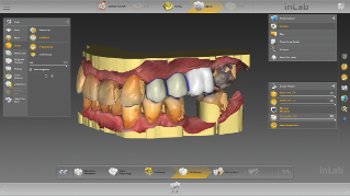 inLab CAD Software, surgical guide for integrated implantology