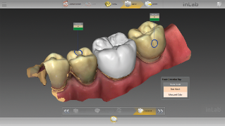 inLab CAD Software, Tooth color display