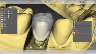 inLab CAD Software, Virtual insertion of a restoration