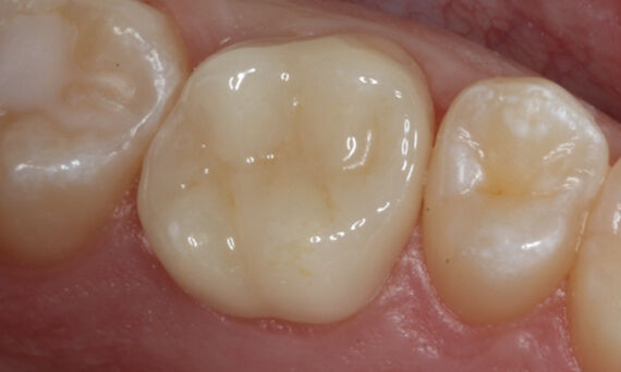 Crown, tooth 14, IPS e.max CAD, Dan Butterman