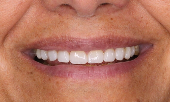10 highly esthetic crowns, teeth 15-25, VITA Suprinity PC, Daniel Vasquez