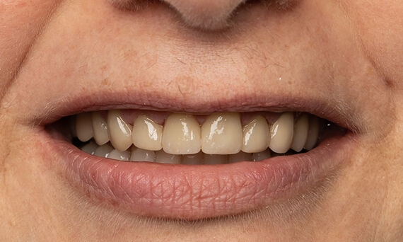 Four highly esthetic and individualized crowns