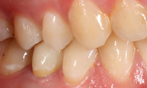 Translucent crown, tooth 45, Katana Zirconia STML, Gertrud Fabel
