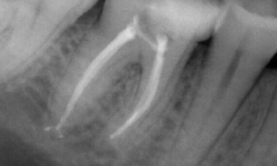 Image of Postoperative X-Ray