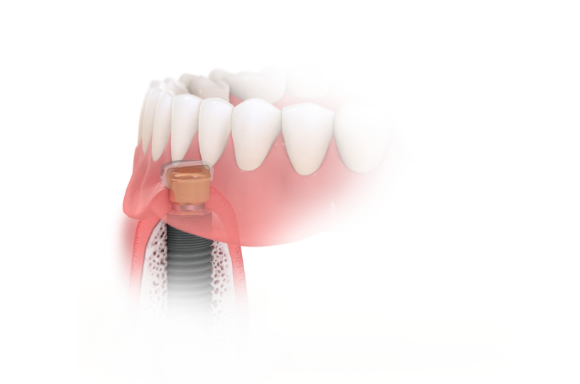 Dental Implant overdentures