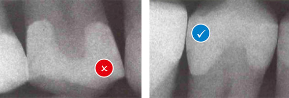 Class II | Palodent Contact Creation Isolation