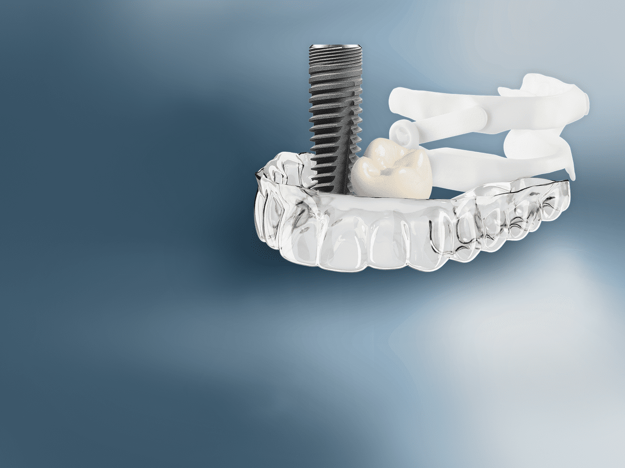 Dental Intraoralscanner 3D Echtzeit Display Software Mit Intraoral 3d Scanner