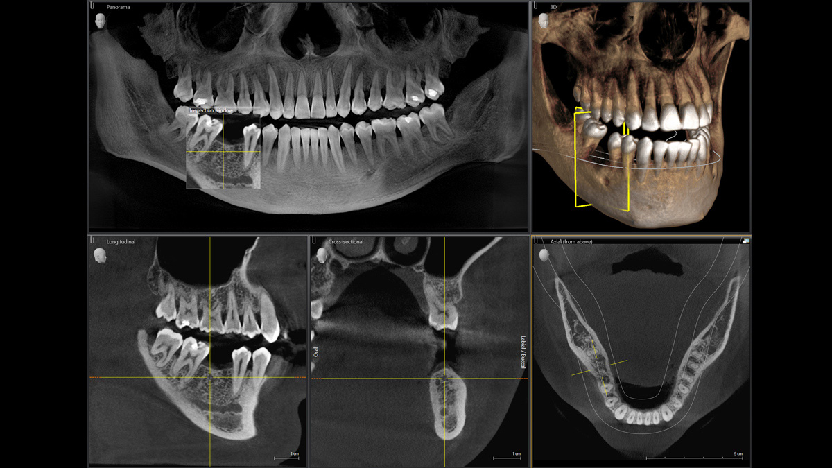 Dental X-Ray of an implant case
