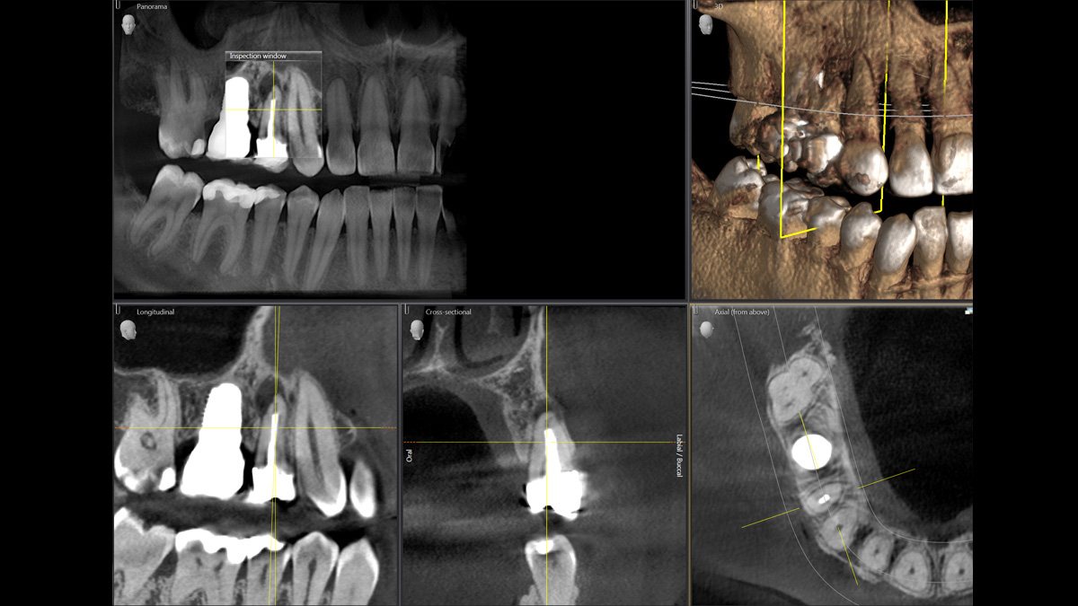 Dental X-Ray 5 cm x 5.5 cm HD 80μm case
