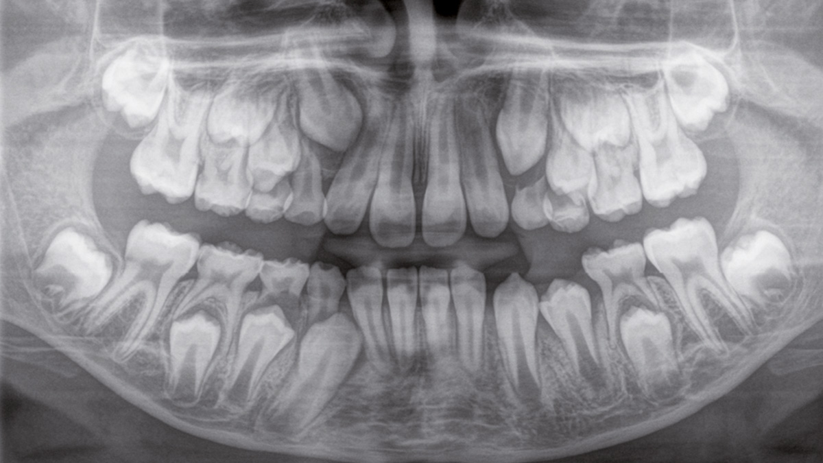 Zahnärztliches Röntgenbild eines Kindes