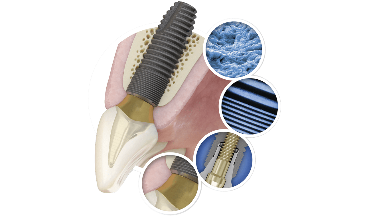 Astra Tech Implant System Dentsply Sirona MENA