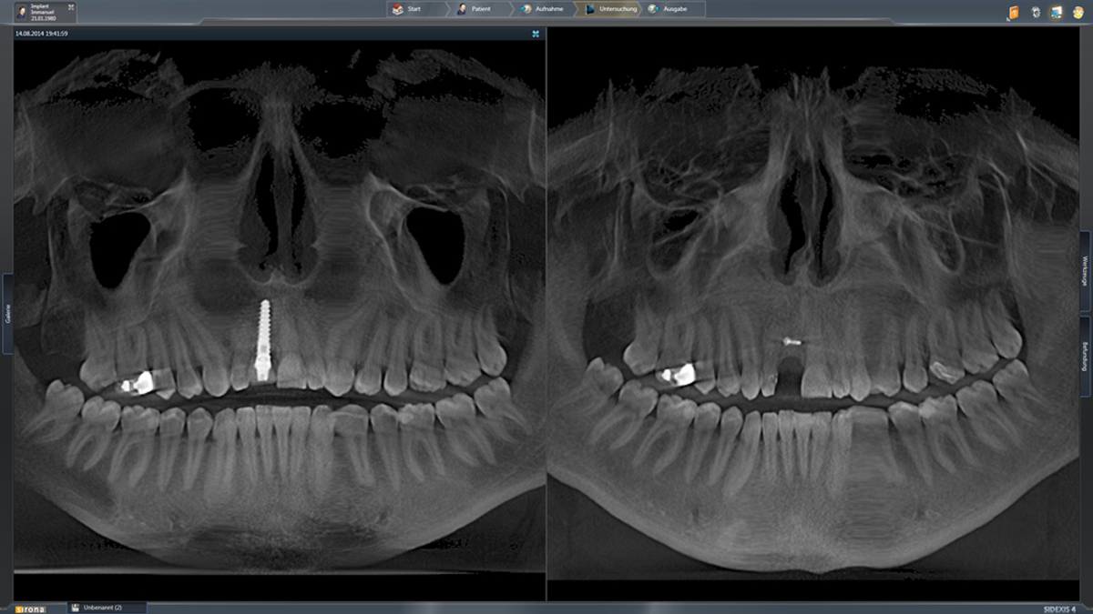 Sidexis 4 3D Compare View