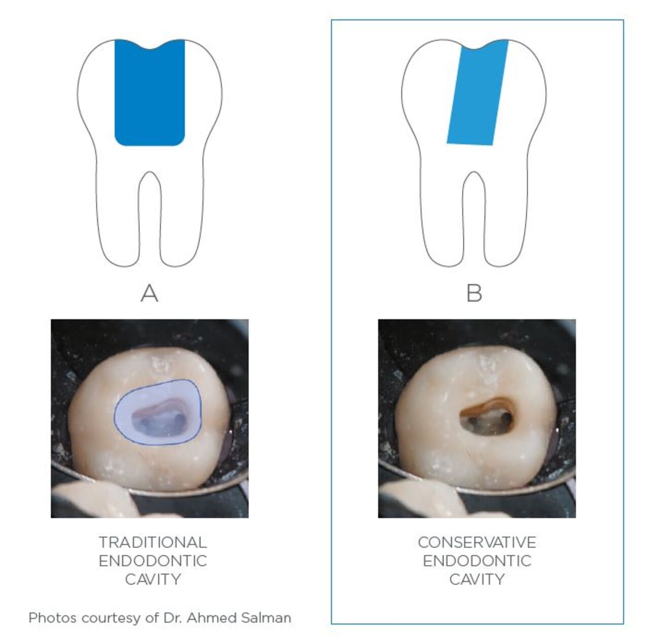 END-Graphics-TruNatomy-endodontic-cavity