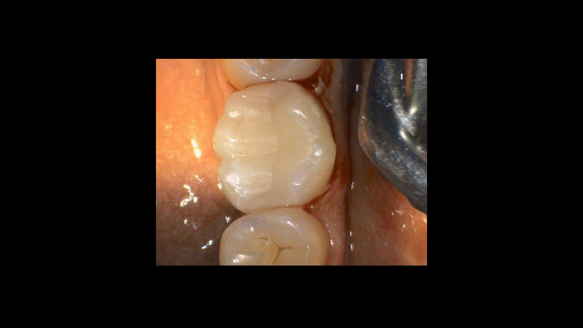 Diode Laser Treatment Videos Dentsply Sirona MENA