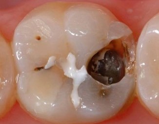 Tooth with caries
