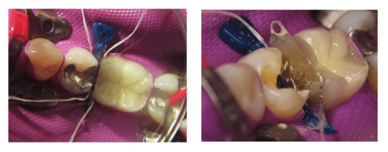 Guide to Class II Restoration Procedures | Dentsply Sirona AL
