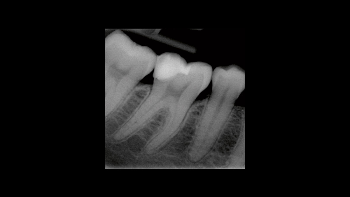 Diode Laser Treatment Videos Dentsply Sirona