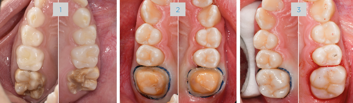 1. Initial findings of teeth 16 and 26. Due to the circular defect extension and hypersensitivity (MIH Treatment-Need-Index Score 4c), both teeth were restored with fullcrowns. 2. At the age of 11, the teeth had erupted so far that restoration margins could be prepared into sound enamel. A shoulder preparation of 1mm width was performed. Clinical situation before adhesive cementation procedure. 3. Situation after adhesive cementation of both crowns (16/26) - Occlusal view.