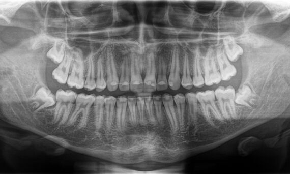 2D x-ray f whole teeth range