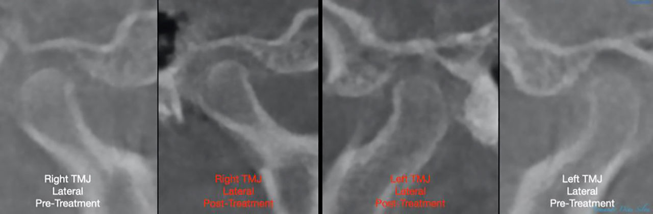 No changes in condyle position