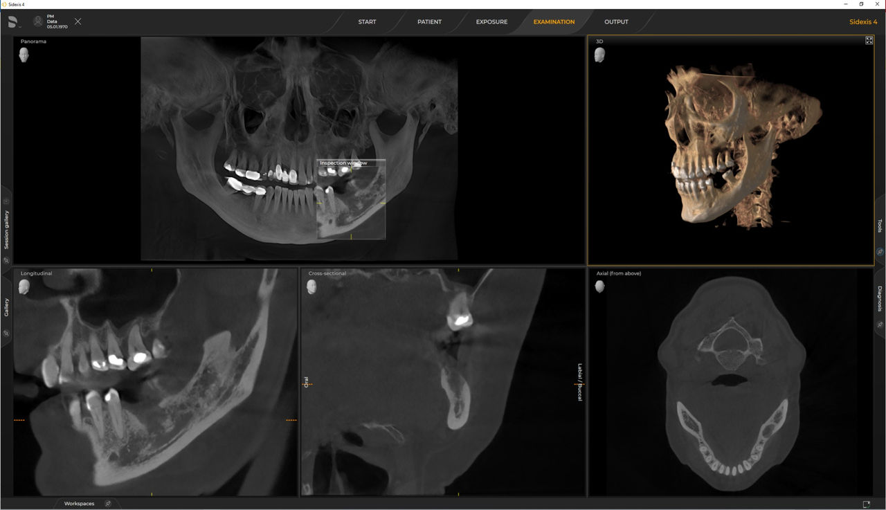 Intelligent Low Dose Indication Example in Sidexis 4