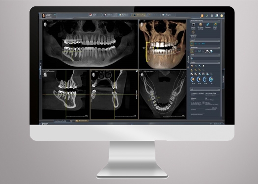 Sidexis 4 3D Dental Software