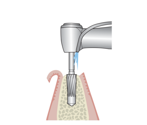 Operation of the conical reamer motorized or manual