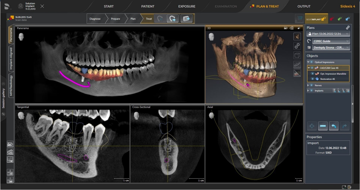 inLab CAD Software, optical scan in combination with 3D X-ray data