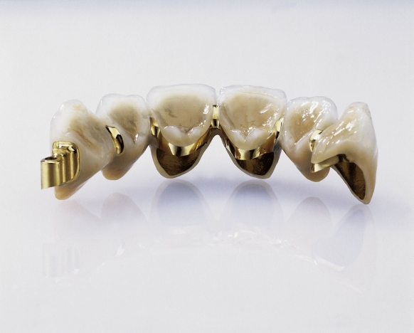 metal-based dental crown and bridge
