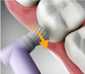 Removing Cordless Prophy Handpiece from Tooth