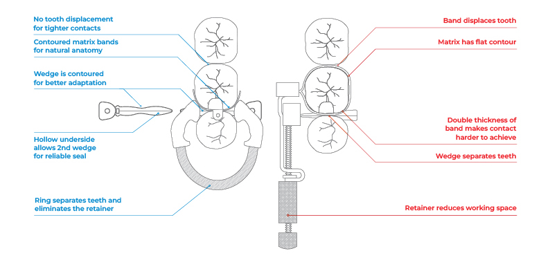 Palodent | Comparison Sectional vs Circumferential System