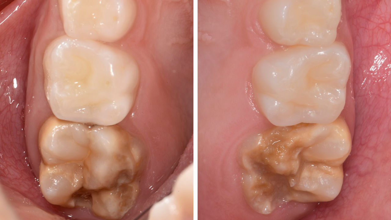 Tooth 16 and 26 affected by severe hypo-mineralisation. MHI-TNI Score 4c (Bekes & Steffen 2016)