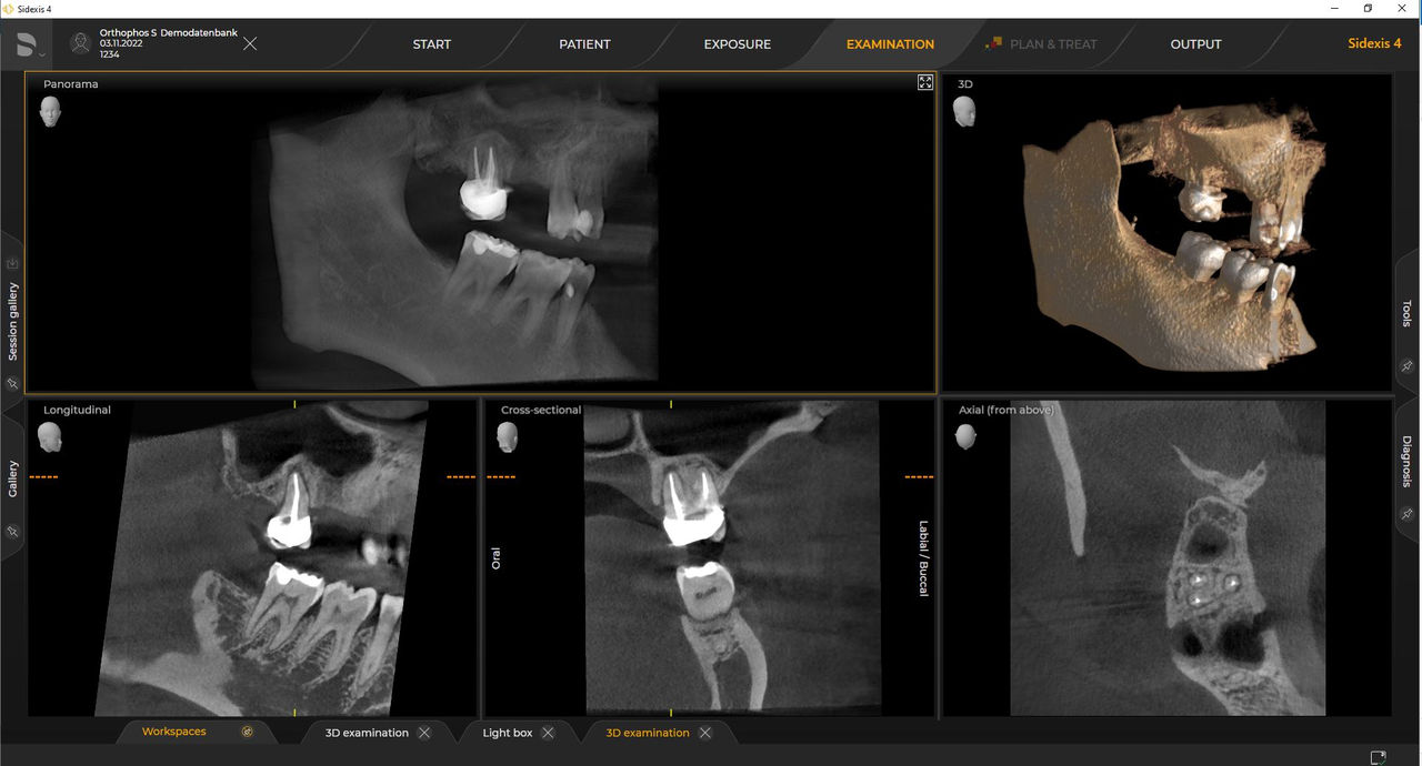 Dental X-Ray