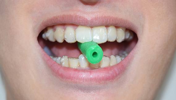 Chewie Aligner Tray Seater in mouth