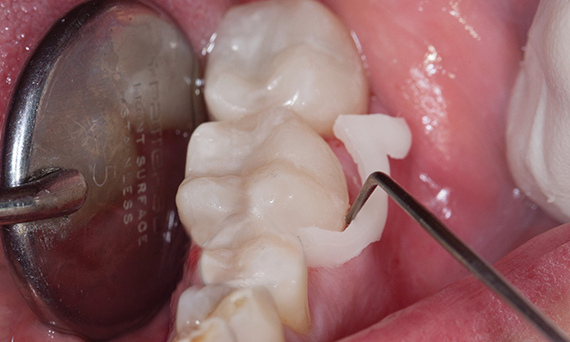 clinical image - cleanup after crown seating