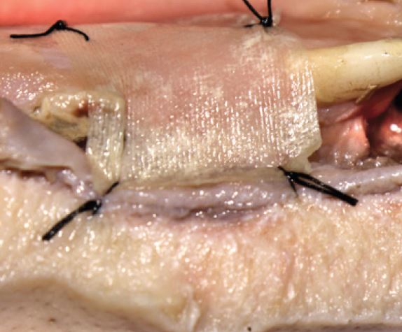 jaw bone with lingual flap