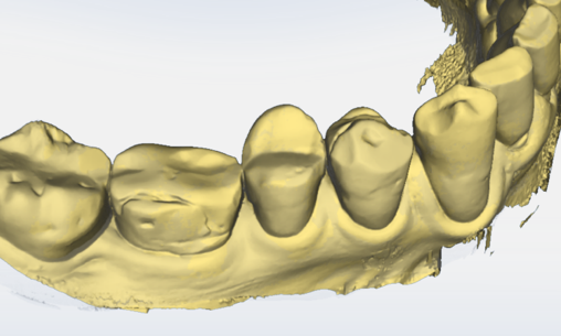Gingival Recession Measurement, after, OraCheck 5
