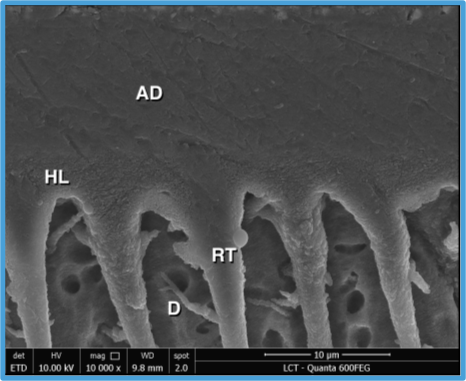 SEM on over dried dentin showing a well-formed hybrid layer and long resin-tags