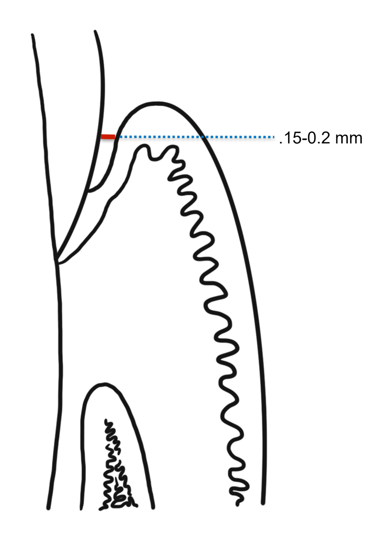 Figure 1 Clinical survival [years] of 676 endodontically treated posterior teeth and cavities with up to three surfaces (three to four remaining walls) by Dammaschke T. aet al., 2013 6