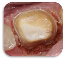 Figure 1 Clinical survival [years] of 676 endodontically treated posterior teeth and cavities with up to three surfaces (three to four remaining walls) by Dammaschke T. aet al., 2013 6