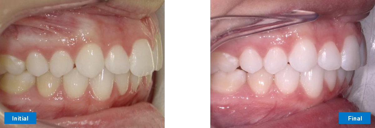Right Buccal