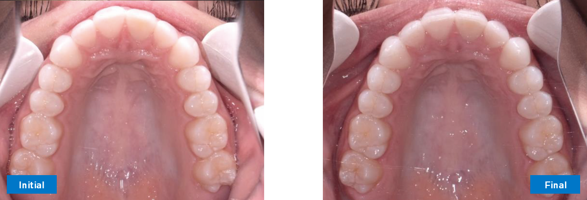 Upper Occlusal