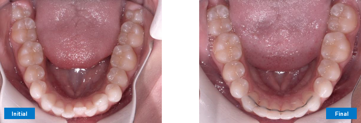 Lower Occlusal