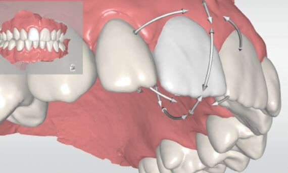 Orthodontics with CEREC Ortho Software